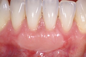 Close up of teeth after gum treatment in Huntington Beach