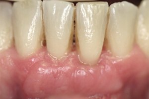Close up of teeth in healthy gums thanks to Huntington Beach periodontist