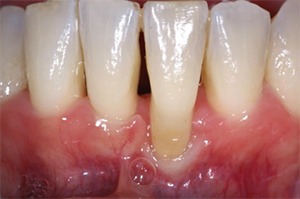 Close up of long lower teeth due to receding gums