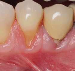 Close up of receding gum tissue around two teeth
