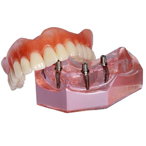 Model of All-on-4 dental implant supported denture