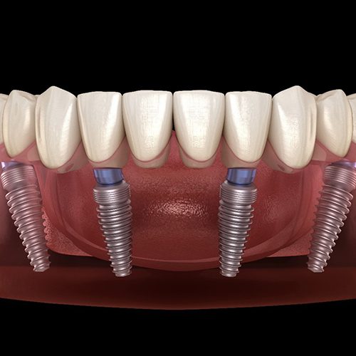 Illustration of full arch supported by All-on-4 in Huntington Beach