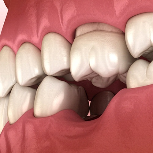 Illustration of tooth loss in the lower jaw