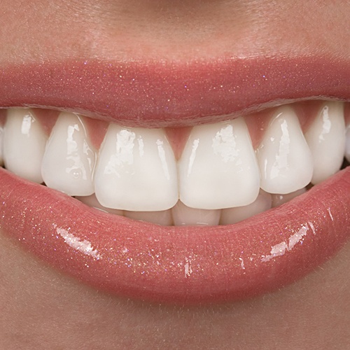 A smile treated by gum recontouring in Huntington Beach.