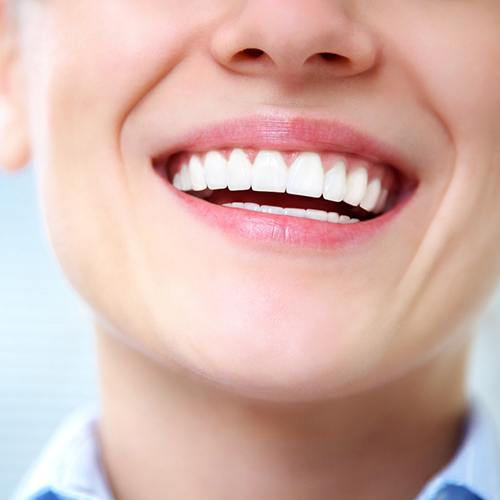 Beautiful smile after gum grafting in Huntington Beach