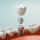 A digital image of a single tooth dental implant and all its parts