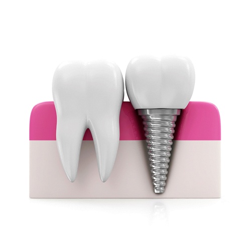 Diagram of an integrated dental implant