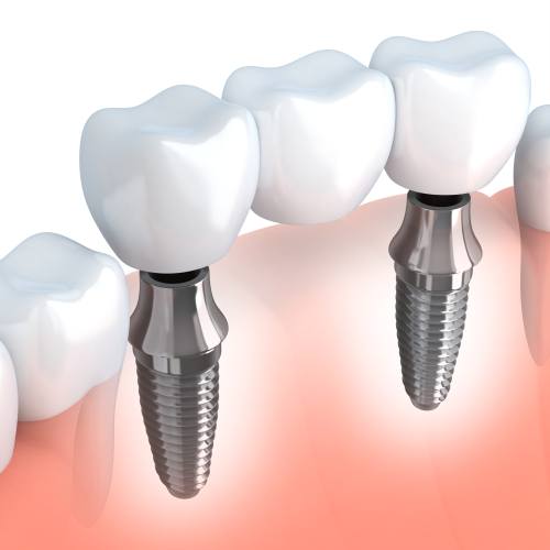 Animated implant supported fixed bridge