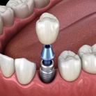 Animation of implant supported dental crown