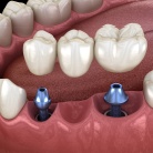 Animation of implant supported fixed bridge