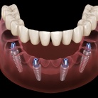 Animation of implant supported denture