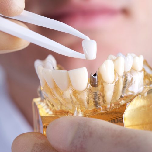 Model smile with implant supported dental crown