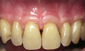 Close up of mouth with normal sized teeth after treatment from Huntington Beach periodontist