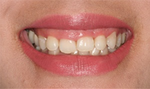 Close up of Huntington Beach woman with gummy smile