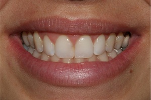Close up of teeth after periodontal treatment in Huntington Beach