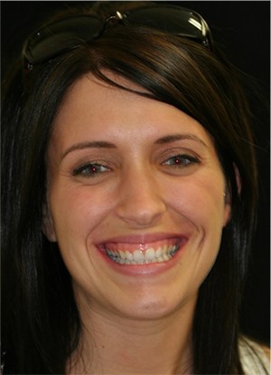 Young woman with gummy smile in Huntington Beach