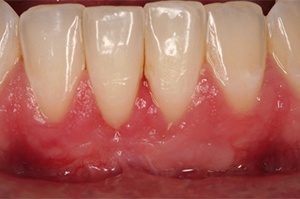 Closeup of mouth with healthy gums