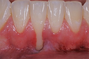Close up of mouth with receding gums