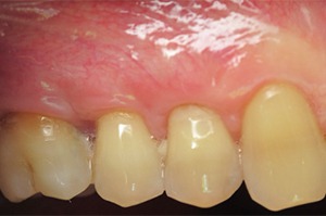 Row of upper teeth with healthy gums