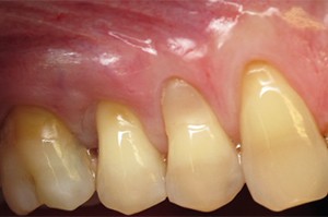 Row of upper teeth with receding gums