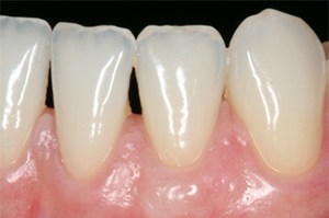 Close up of Huntington Beach periodontal patient with healthy gums