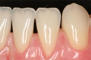 Close up of Huntington Beach periodontal patient with receding gums