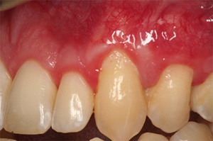 Close up of a mouth with normal sized gums thanks to Huntington Beach periodontist