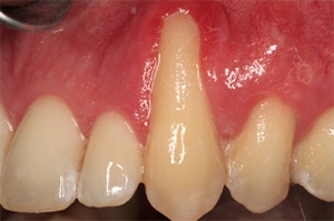 Close up of a mouth with receding gums around one tooth