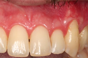 Close up of a tooth with healthy gum tissue after being treated by Huntington Beach periodontist