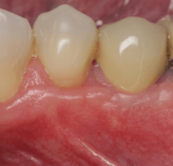 Close up of two teeth with healthy gum tissue after periodontal care in Huntington Beach