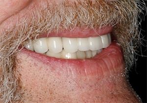 Close up of bearded man smiling with full set of teeth