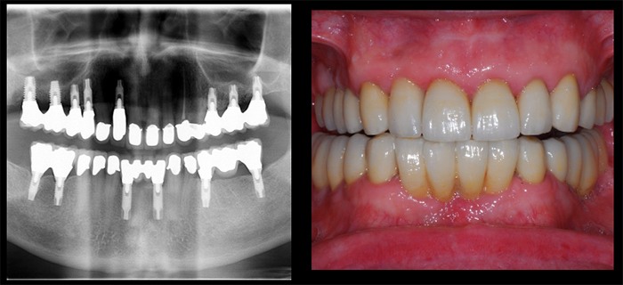 Before and after images of a smile after getting dental implants from Huntington Beach periodontist