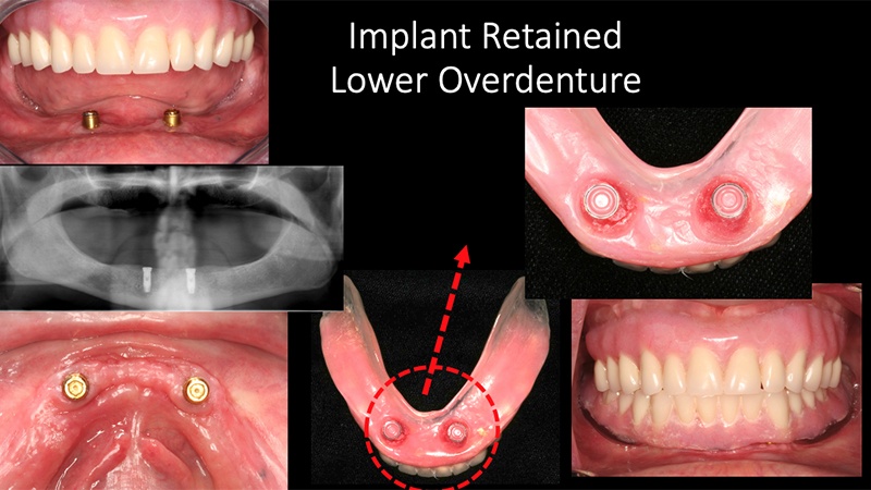 Collage of images of the mouth of a periodontal patient in Huntington Beach