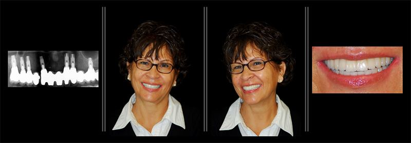 Collage of images of woman smiling before and after periodontal treatment in Huntington Beach