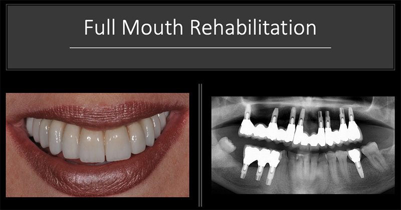 Woman smiling before and after full mouth reconstruction from Huntington Beach periodontist