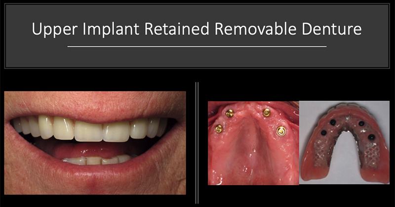 Man smiling before and after getting implant denture from periodontist in Huntington Beach