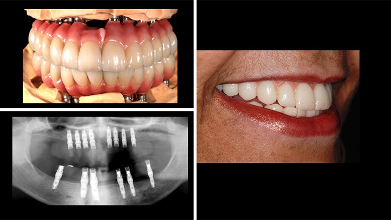 Model of implant denture and close up of woman smiling after getting one