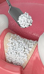 Digital image of a dental bone graft