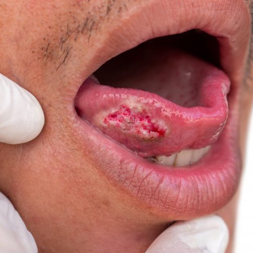 Close up of an abnormal sore on a patient’s tongue