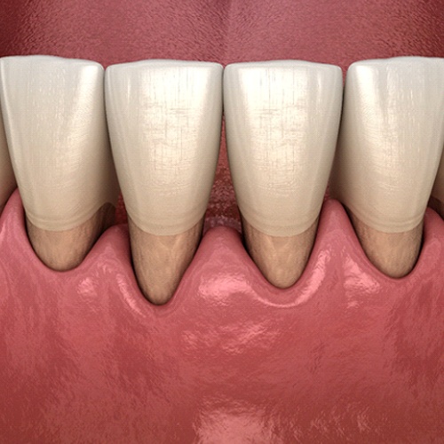 Illustration of gum recession causing pockets around teeth
