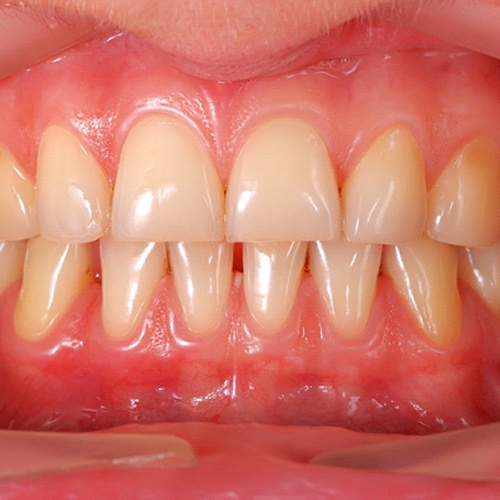 A smile with mild gum disease.