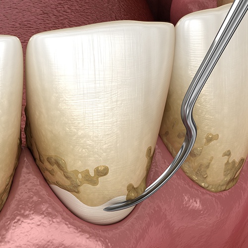 Animation of scaling and root planing treatment