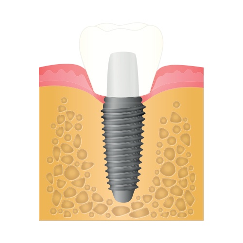 Animation of implant post in grafted bone tissue