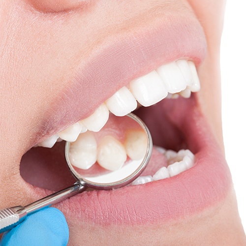 Closeup of healthy smile after tissue graft