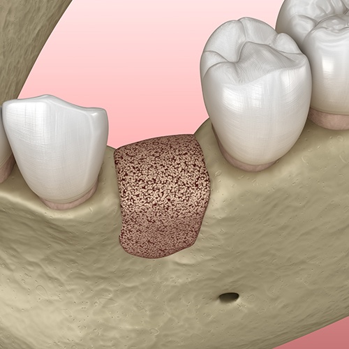 Animation of ridge preservation treatment