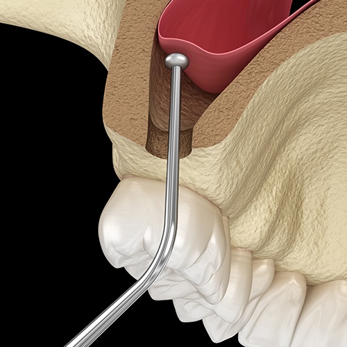 Animation of sinus augmentation process