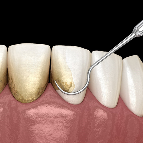 Woman pulling on lip and showing signs of gum disease