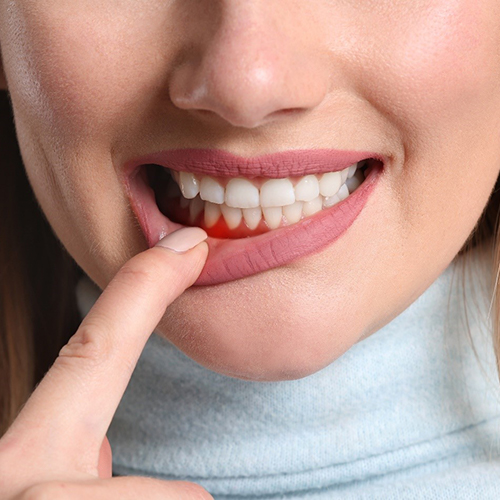 Woman pulling on lip and showing signs of gum disease