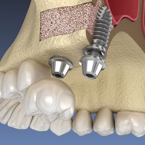 Illustration of dental implants in jawbone after sinus augmentation