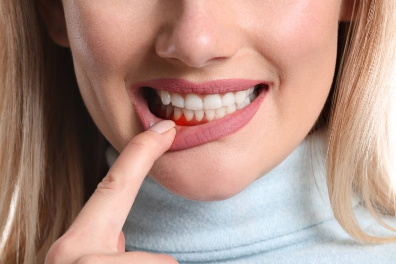 Woman lowering lip to show signs of gum disease